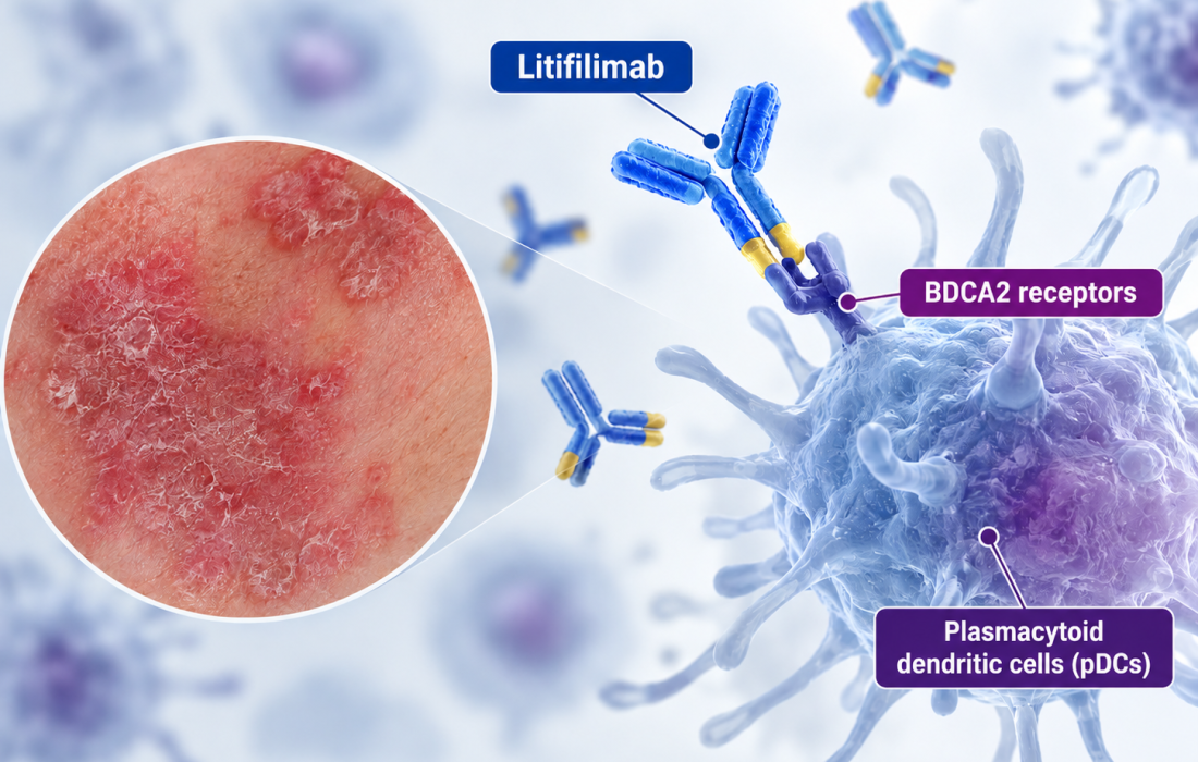 Litifilimab Targeting Dendritic Cells