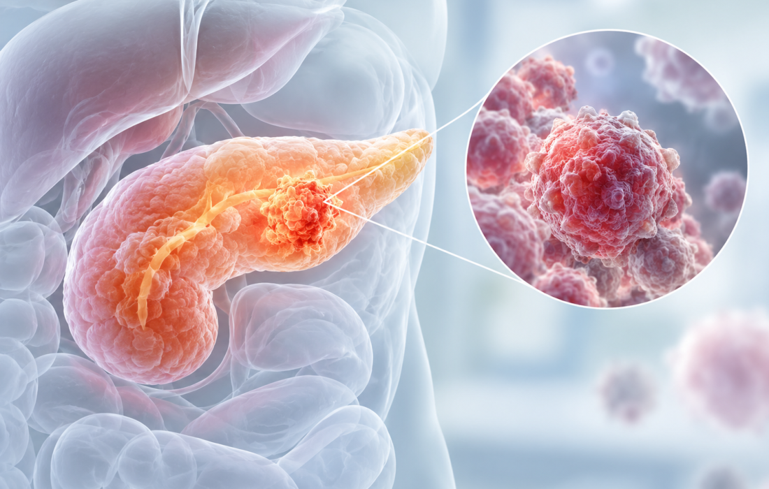 Illustration of investigational cancer therapy targeting MTAP-deleted pancreatic cancer cells