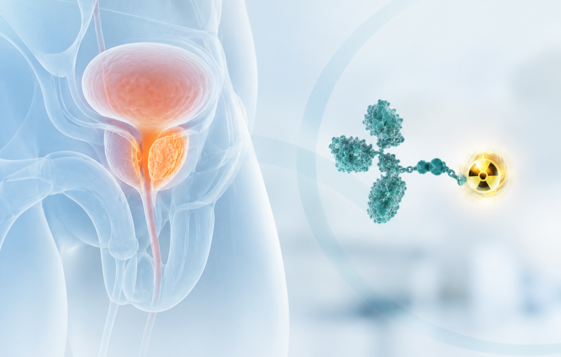 Lead-212-based PSMA-targeted alpha therapy ADVC001 under clinical evaluation for metastatic prostate cancer