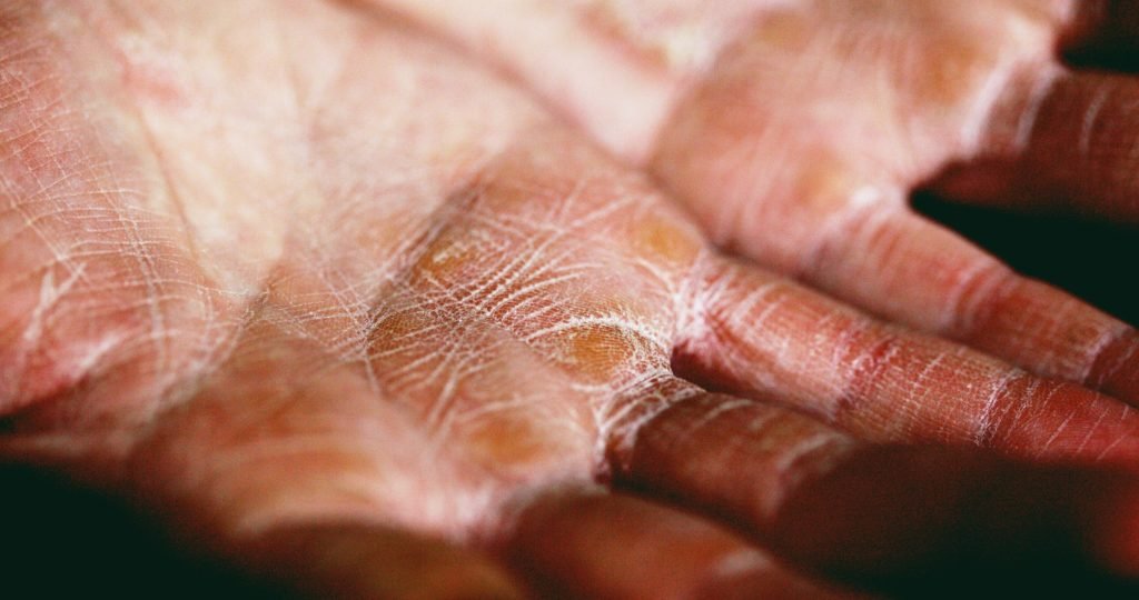 Illustration of plaque psoriasis affecting the scalp, nails, palms, and soles highlighting Phase 3 results of Takeda's investigational TYK2 inhibitor zasocitinib (TAK-279).