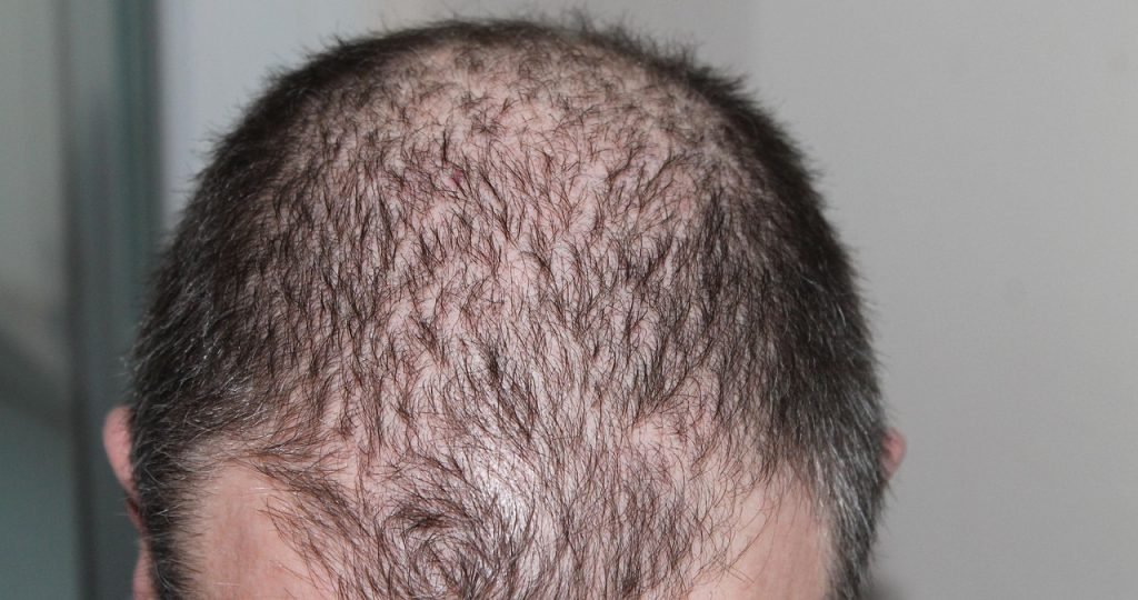 hair, man, hair loss, head, hair loss, hair loss, hair loss, hair loss, hair loss