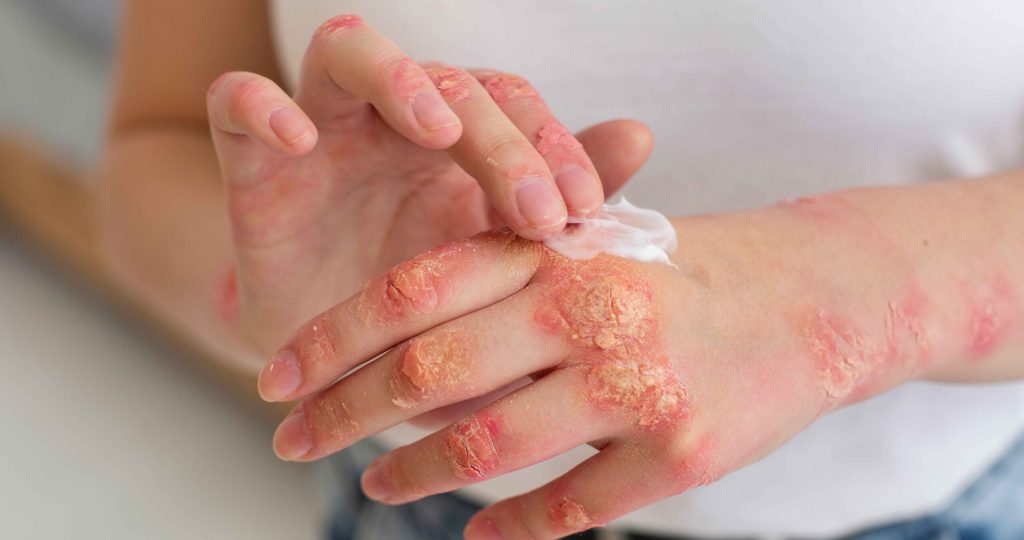hands-patient-suffering-from-psoriasis_11zon