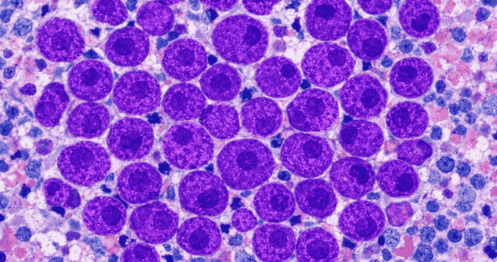 lymphoma