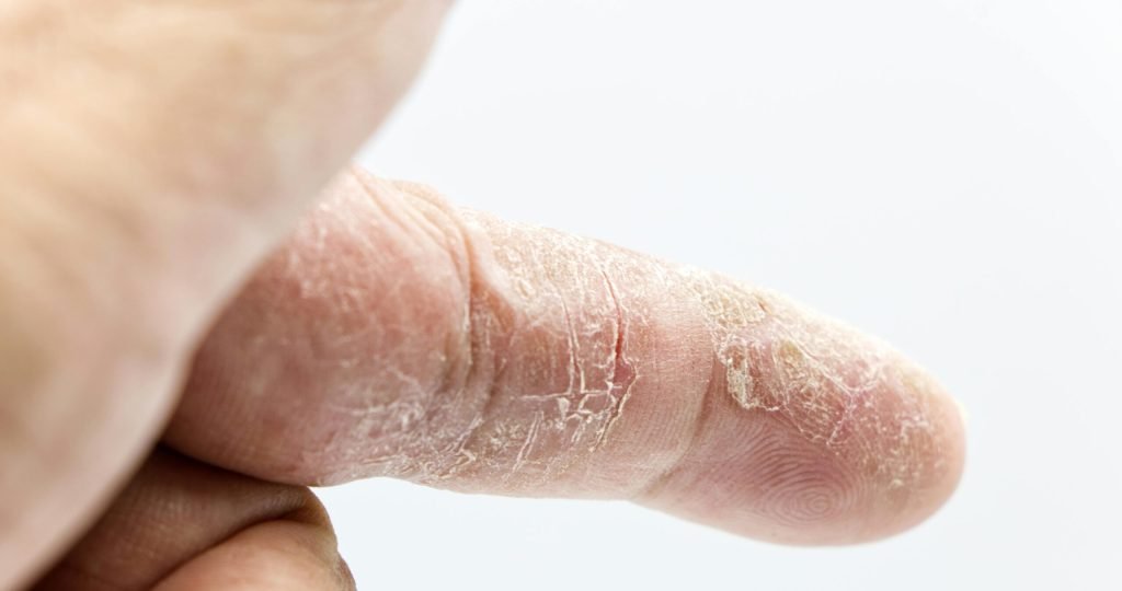 Detailed close-up of a human finger with dry and calloused skin showcasing texture and skin condition.