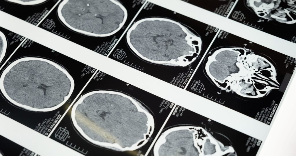Illustration of intracranial gamma-delta T cell therapy INB-200 for glioblastoma treatment alongside temozolomide chemotherapy.