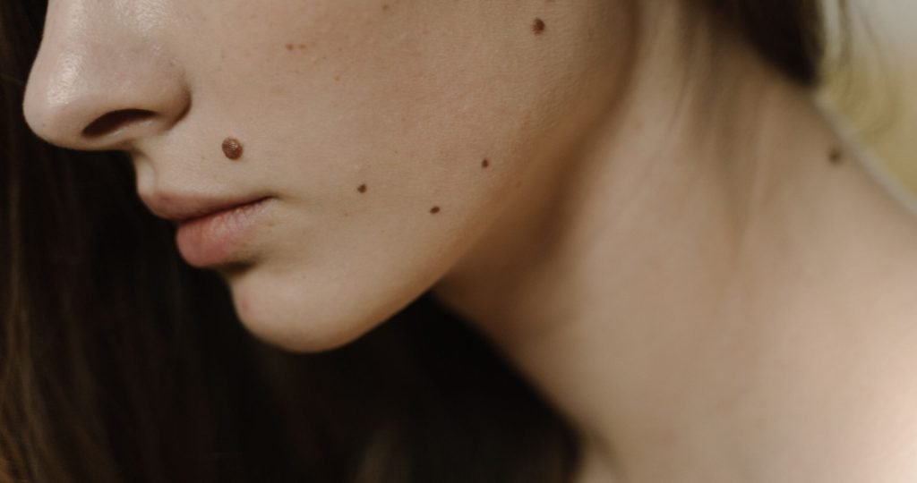 Detailed close-up of a woman's face, focusing on skin with multiple moles.