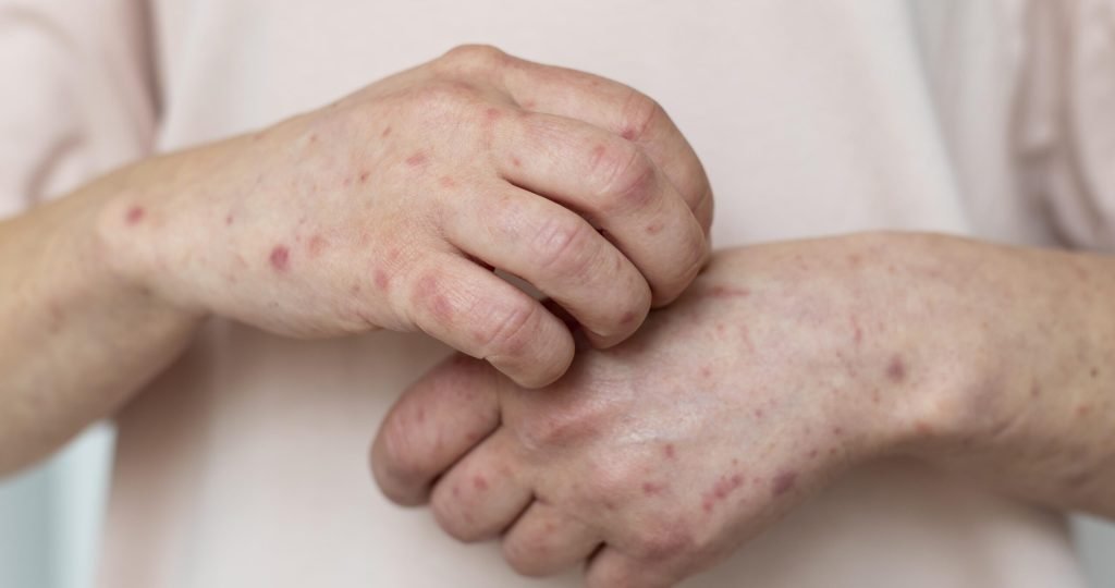 skin-allergy-person-s-arm
